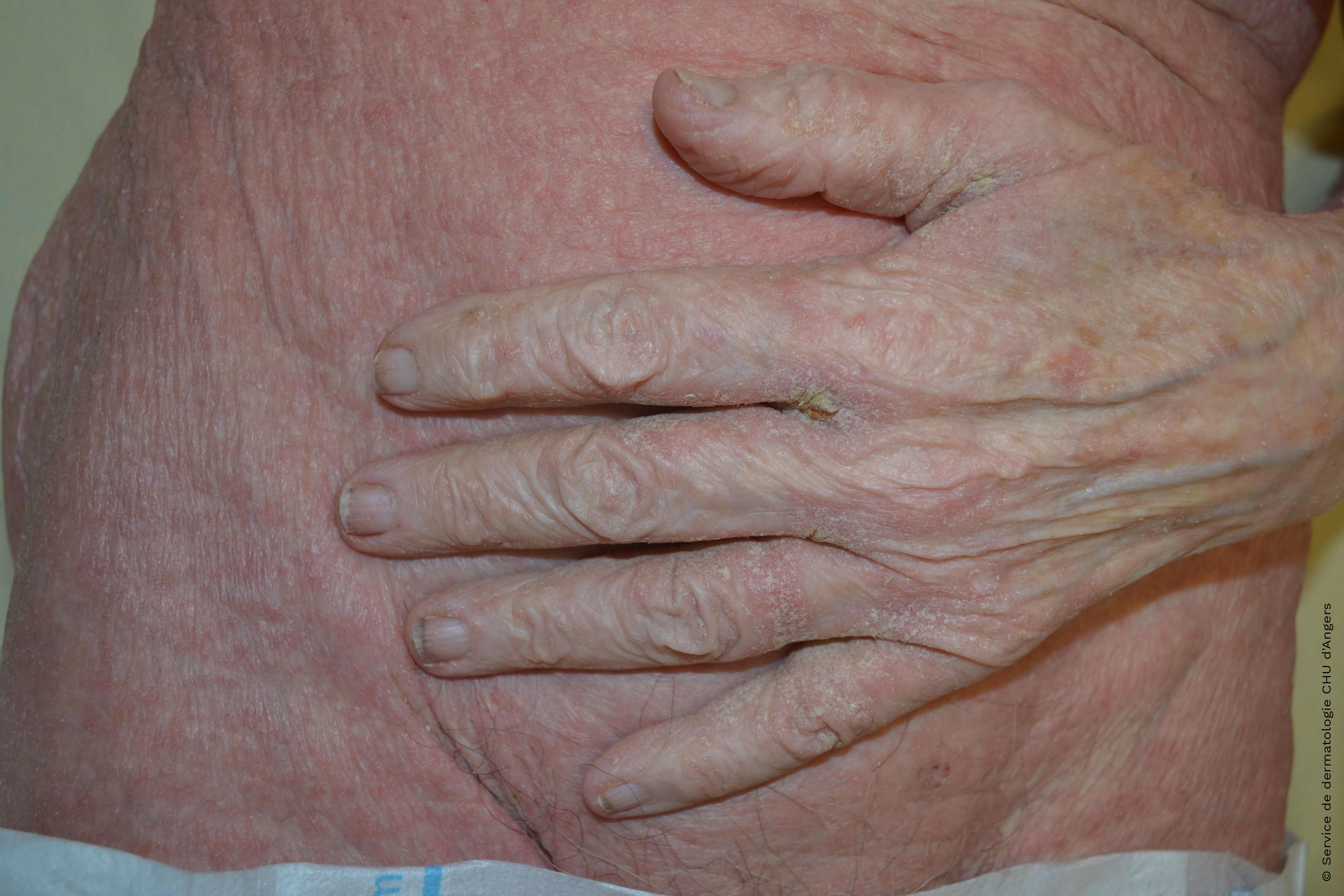 Profuse scabies of the elderly subject