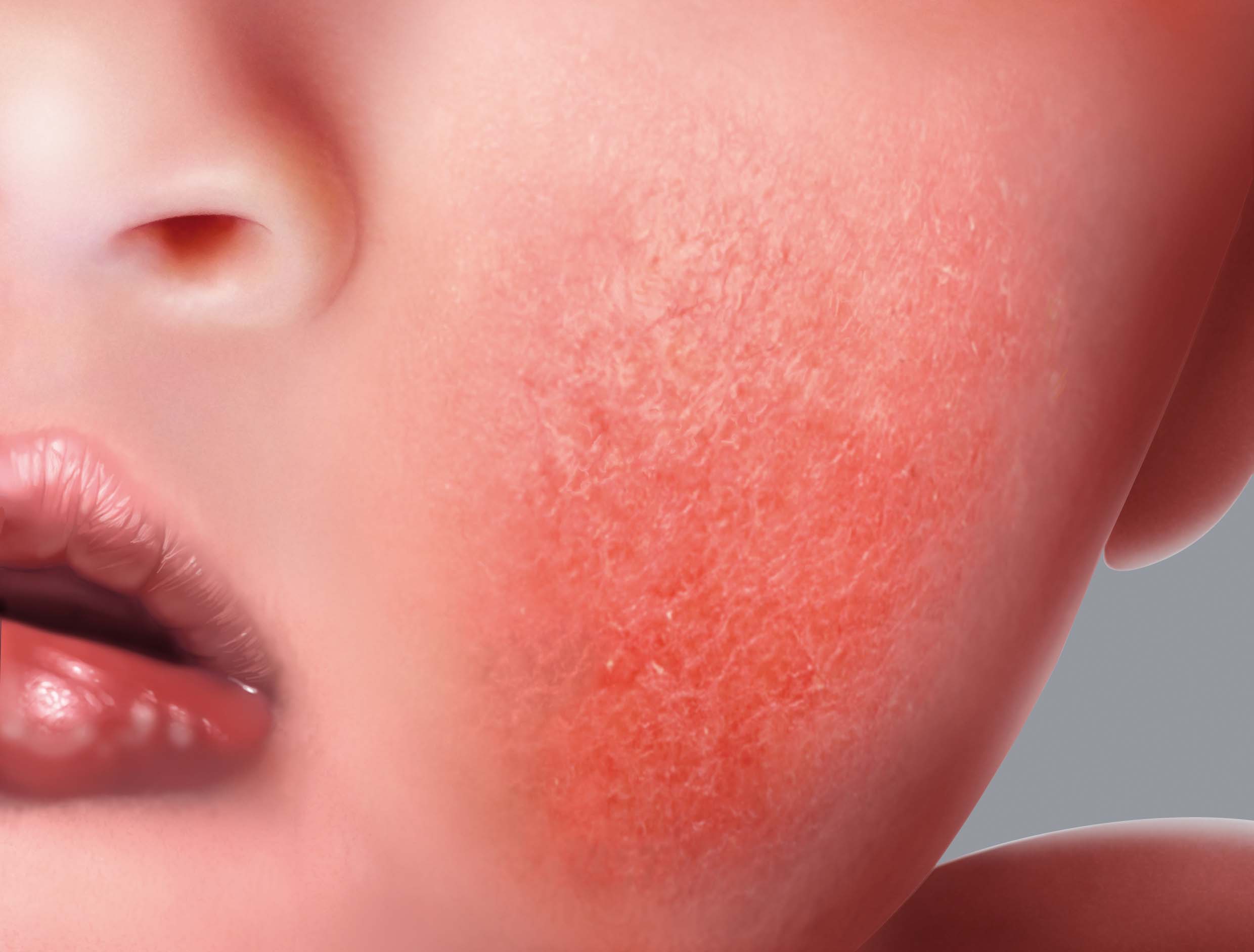 Atopic eczema symptoms: red patches or erythema