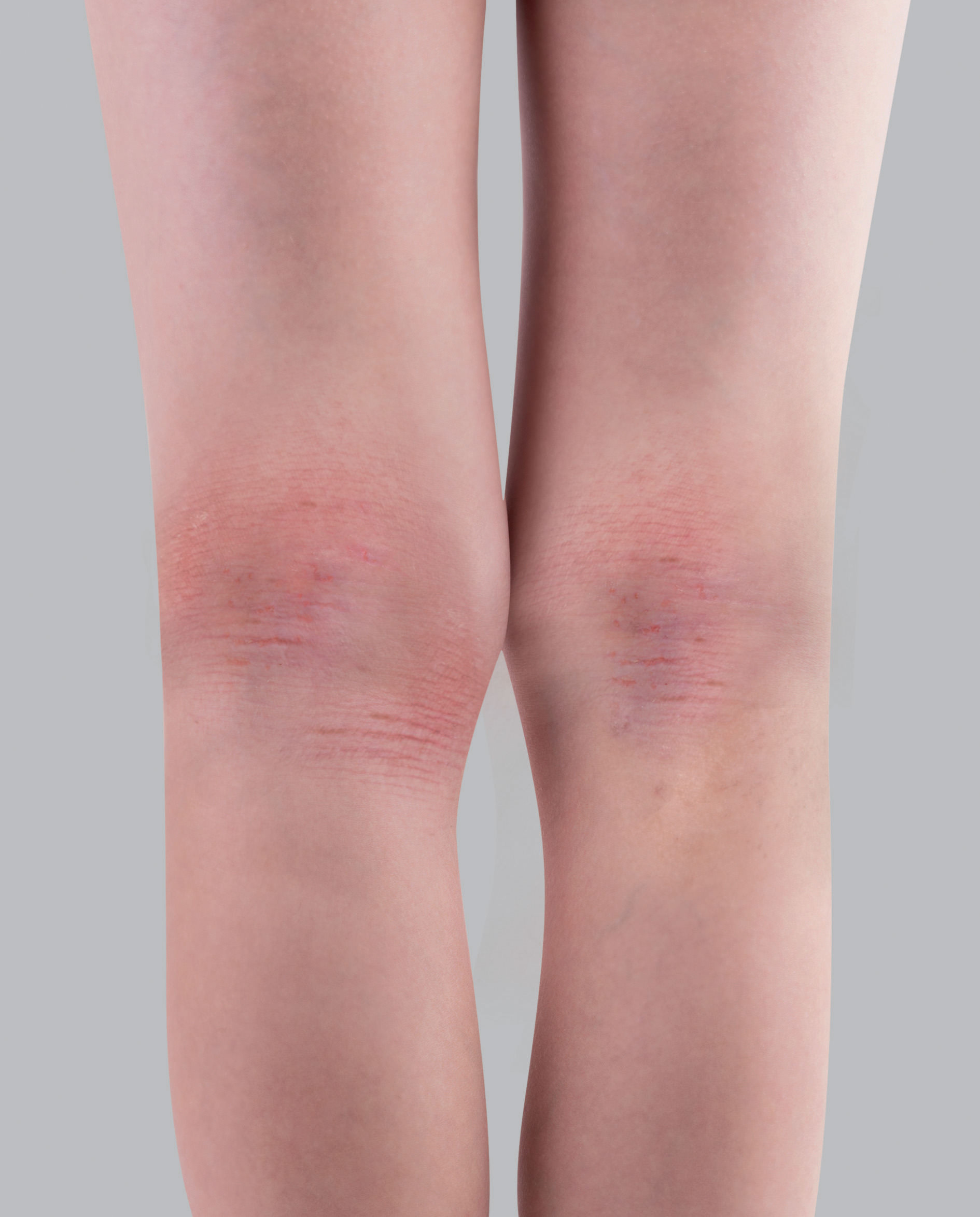 Síntomas del eczema atópico: engrosamiento de la piel o liquenificación