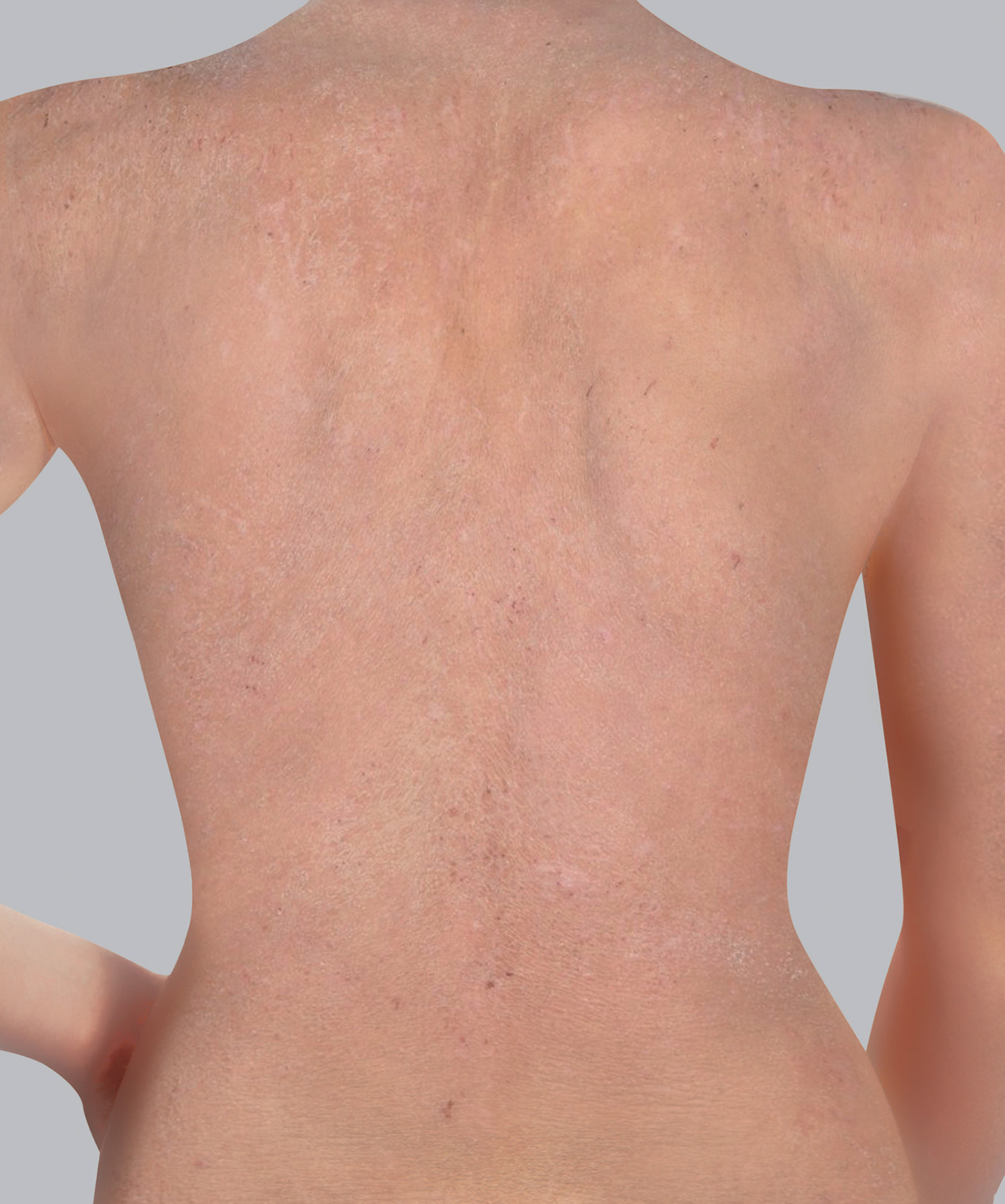 Atopic eczema symptoms: dry / very dry skin or xerosis