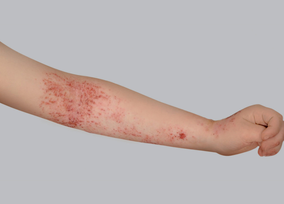 Atopic eczema symptoms: marks from scratching or excoriation