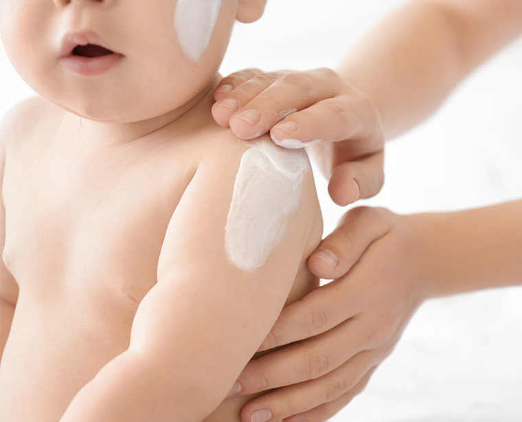 Las cremas y los tratamientos locales para el eczema