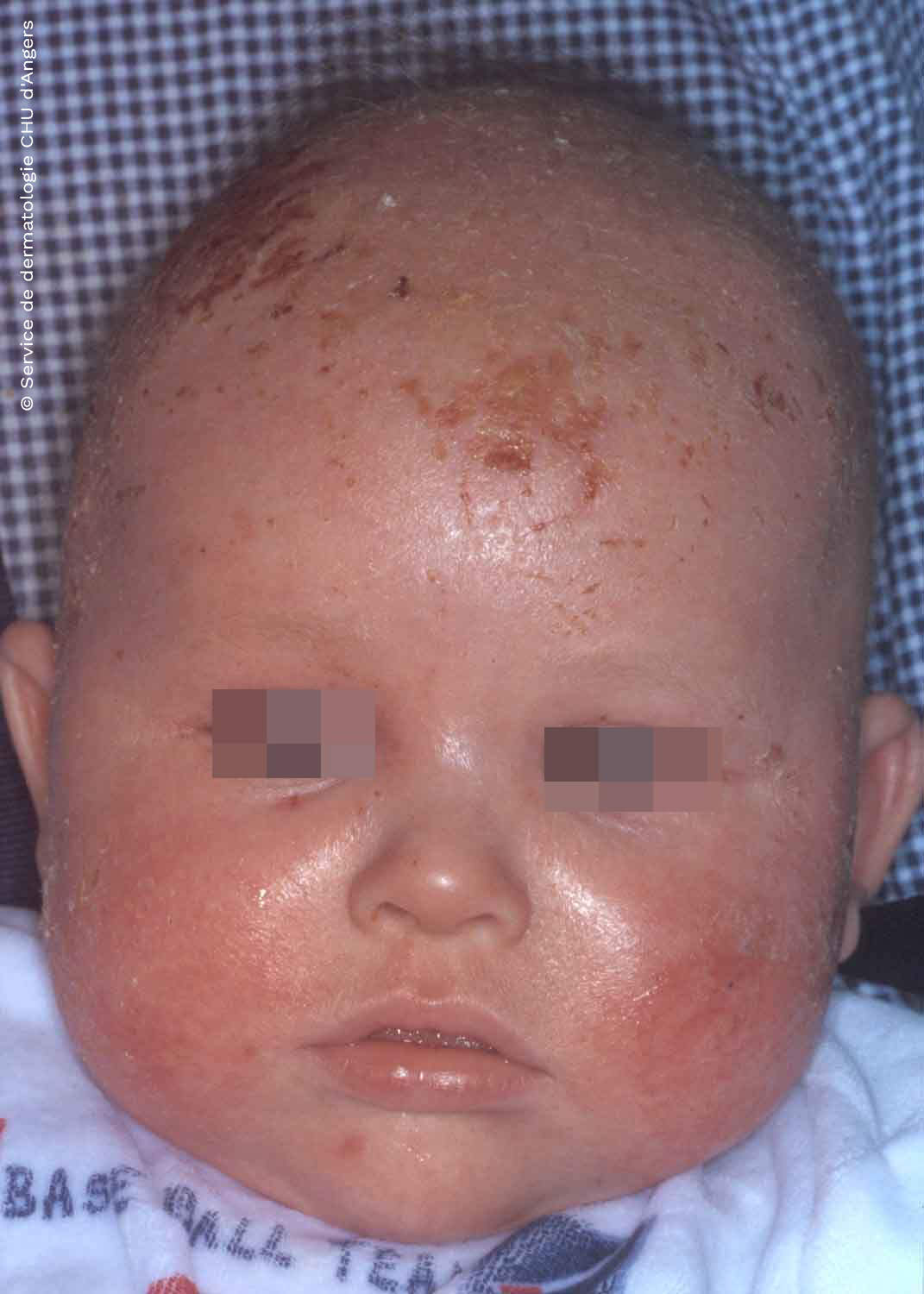Dermatite atopique de l'enfant