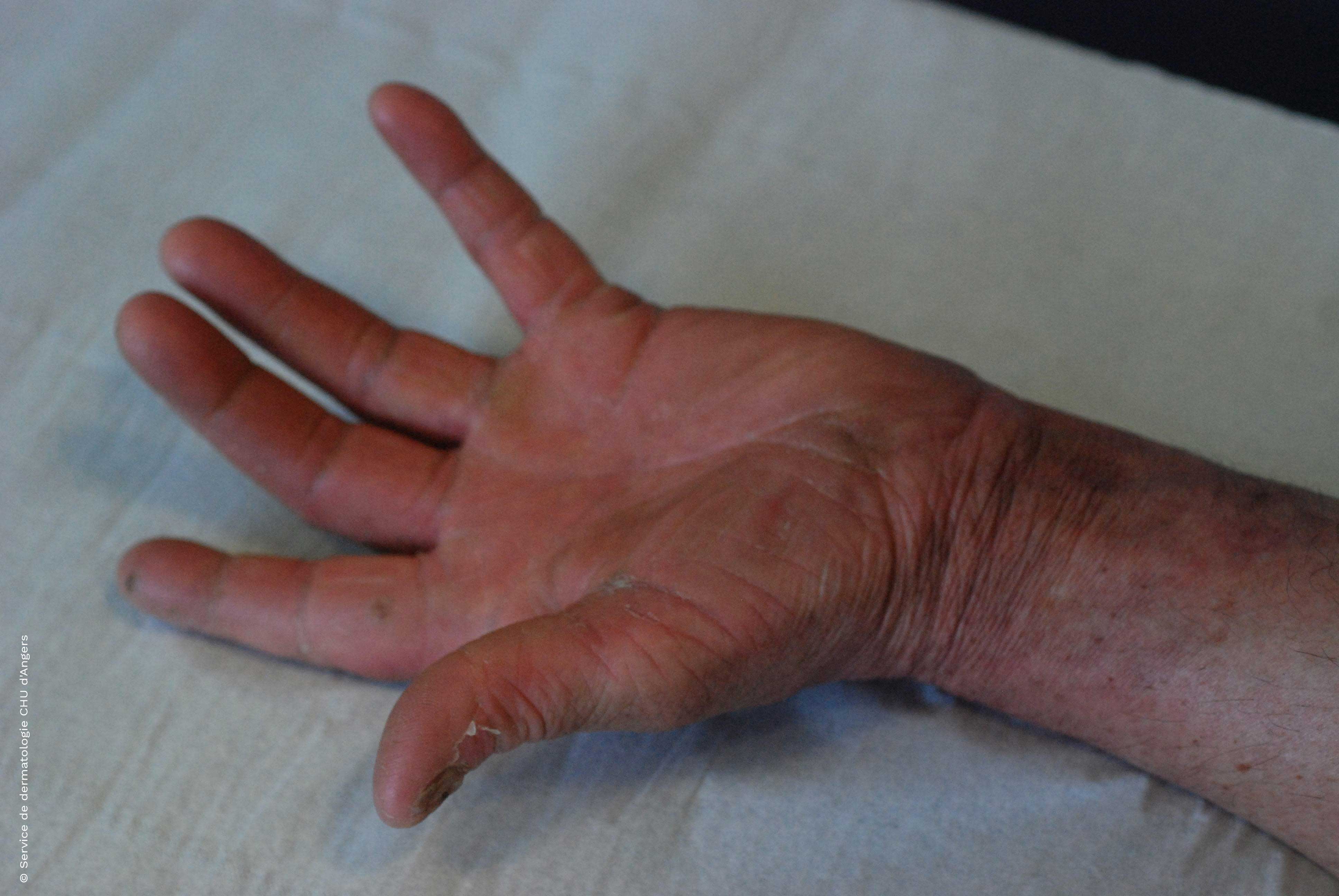  Dermatophytie de la main après traitement antifongique