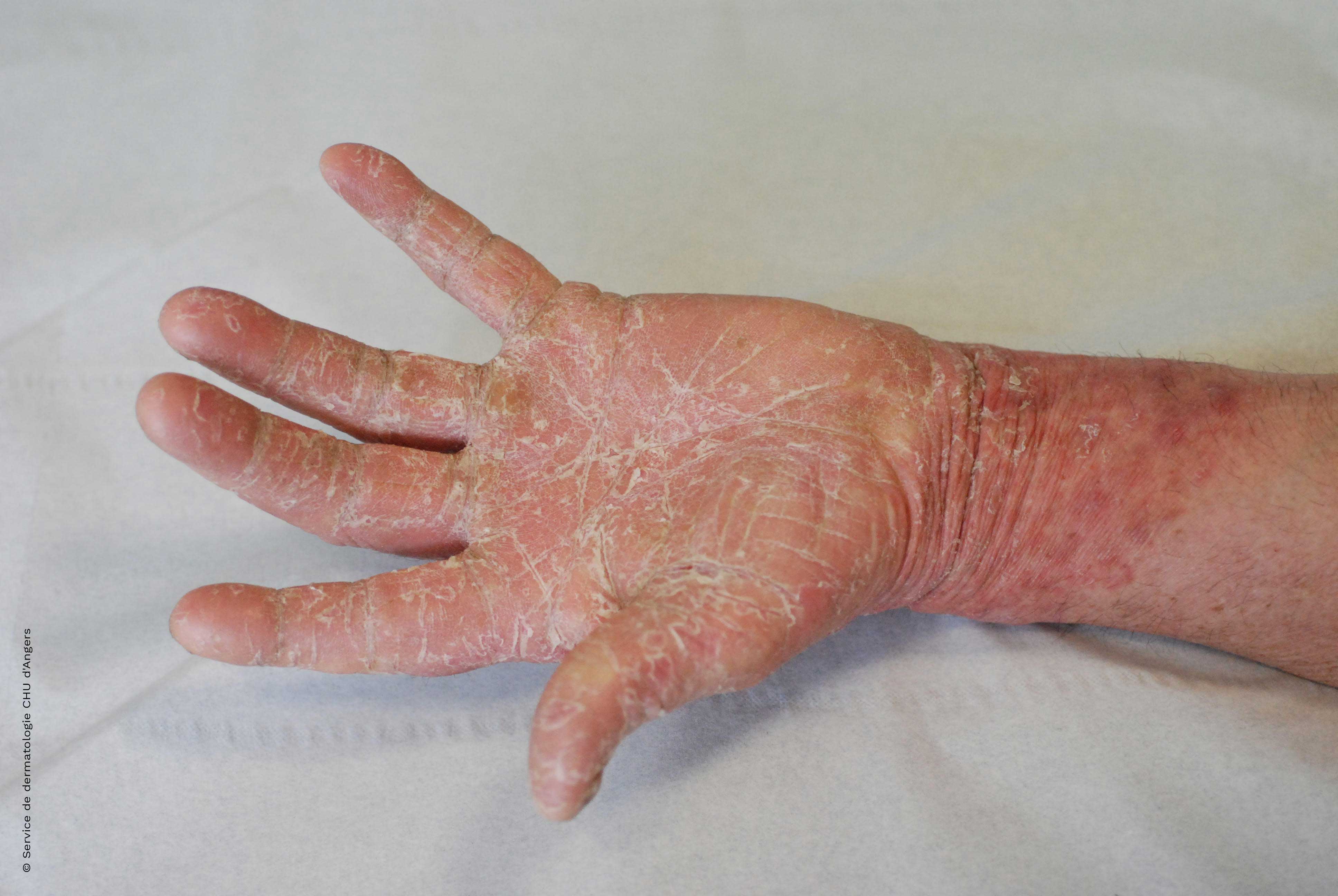 Hand dermatitis - differential diagnosis eczema