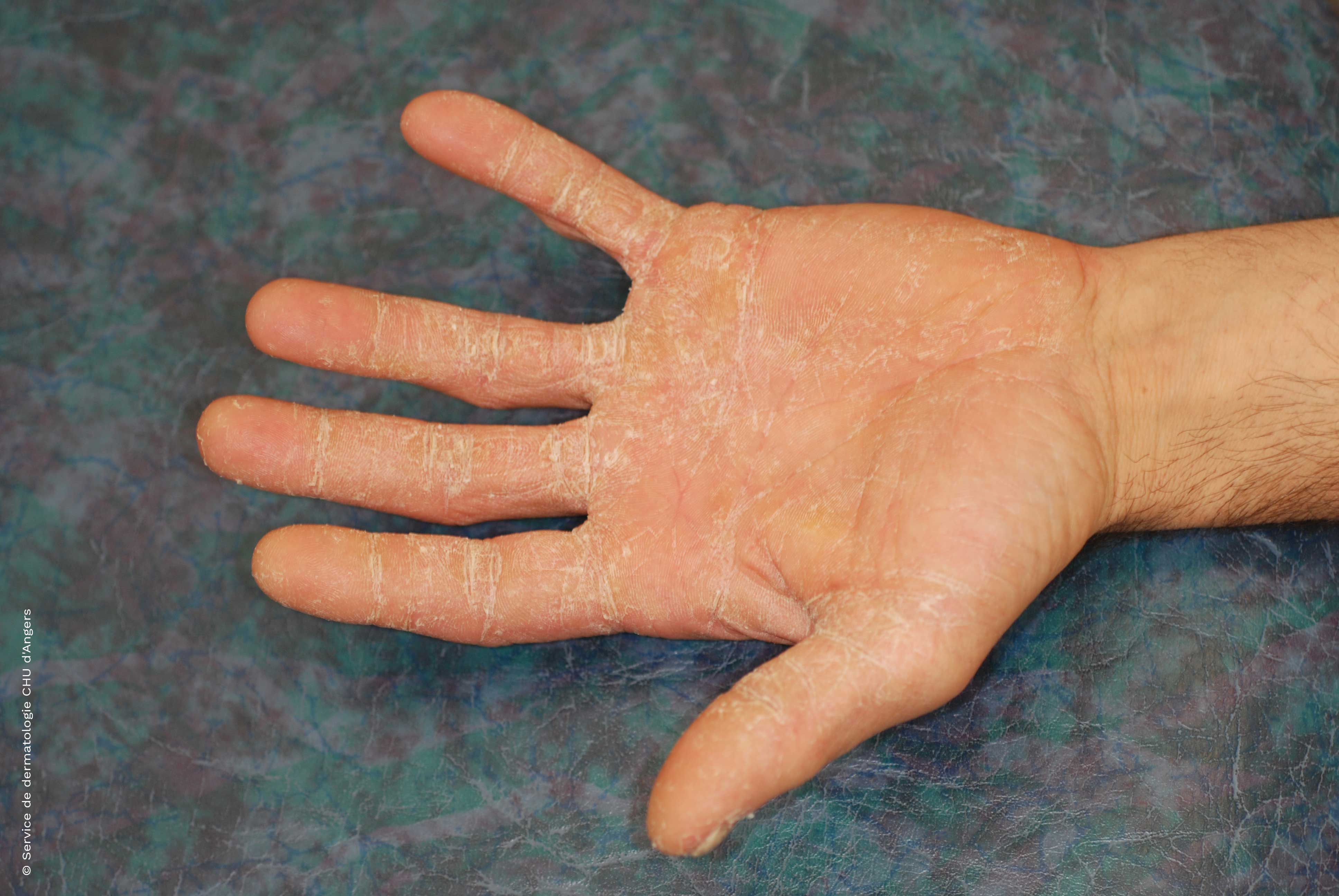 Dermatitis of the palm of the hand - differential diagnosis eczema