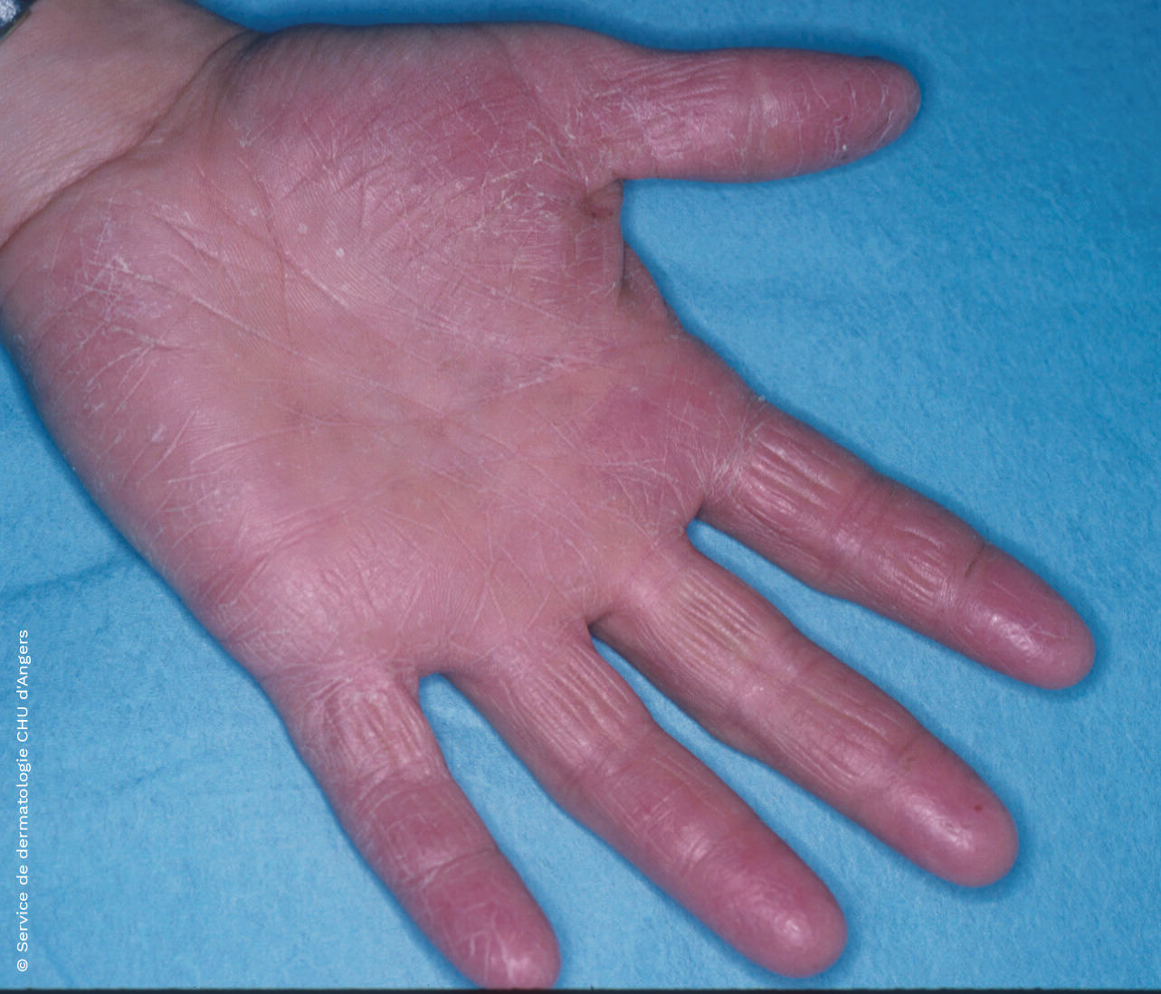 Irritative eczema of the hand