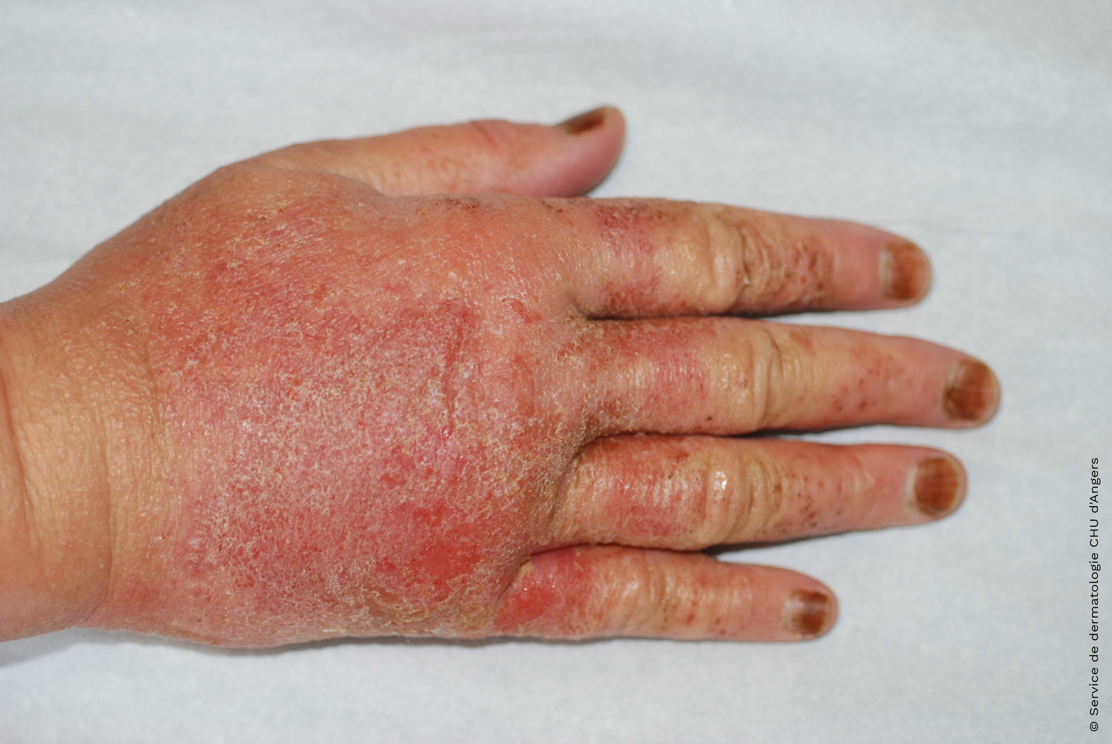 Acute allergic eczema of the hands with tea tree oil