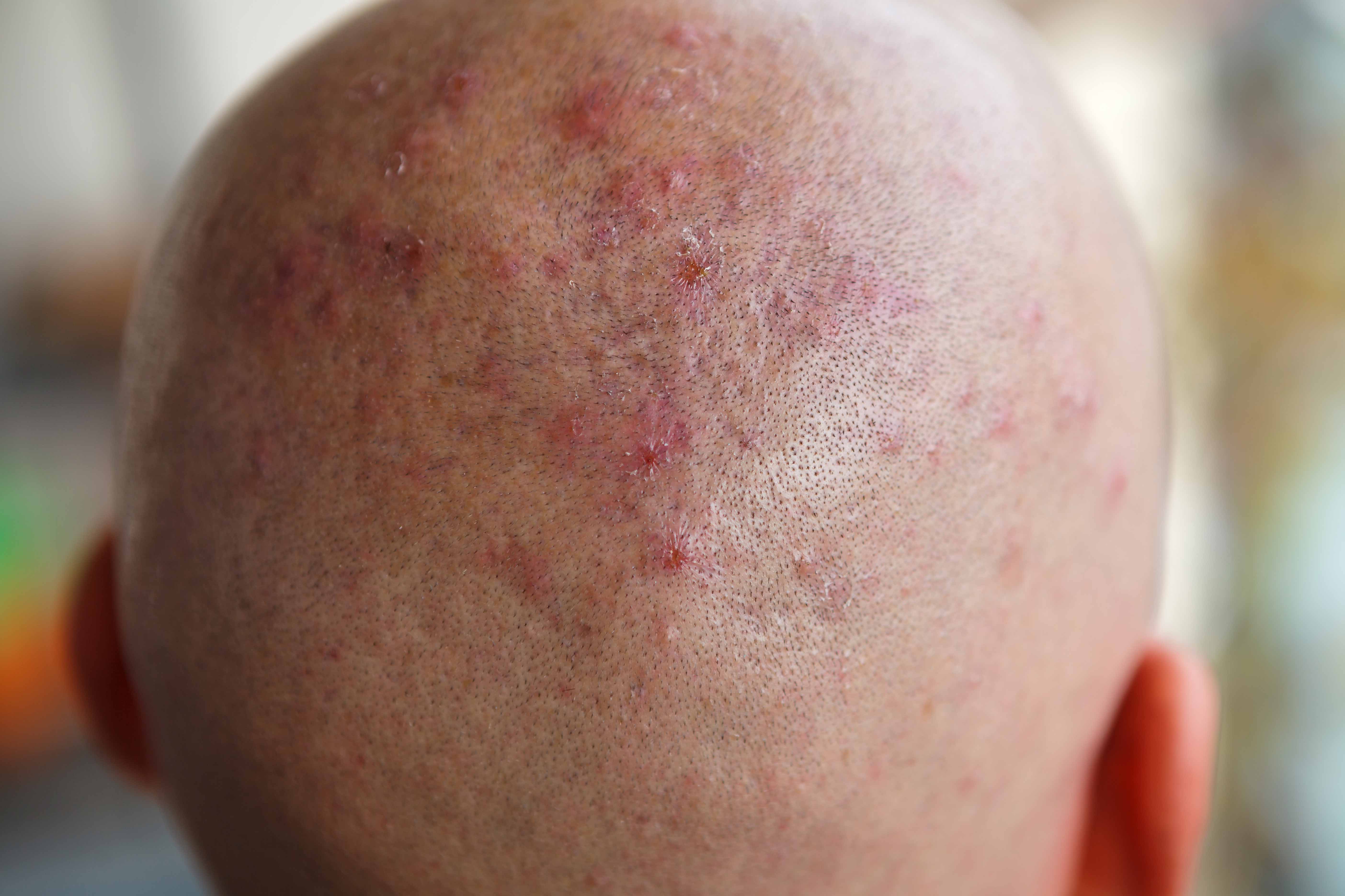 Allergic eczema on the scalp