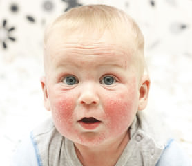 Atopic eczema of the face