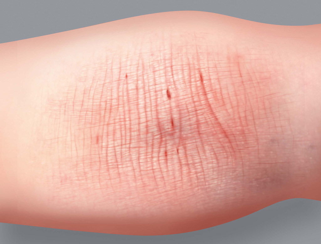 Atopic eczema symptoms : Thickening of the skin (Lichenification)