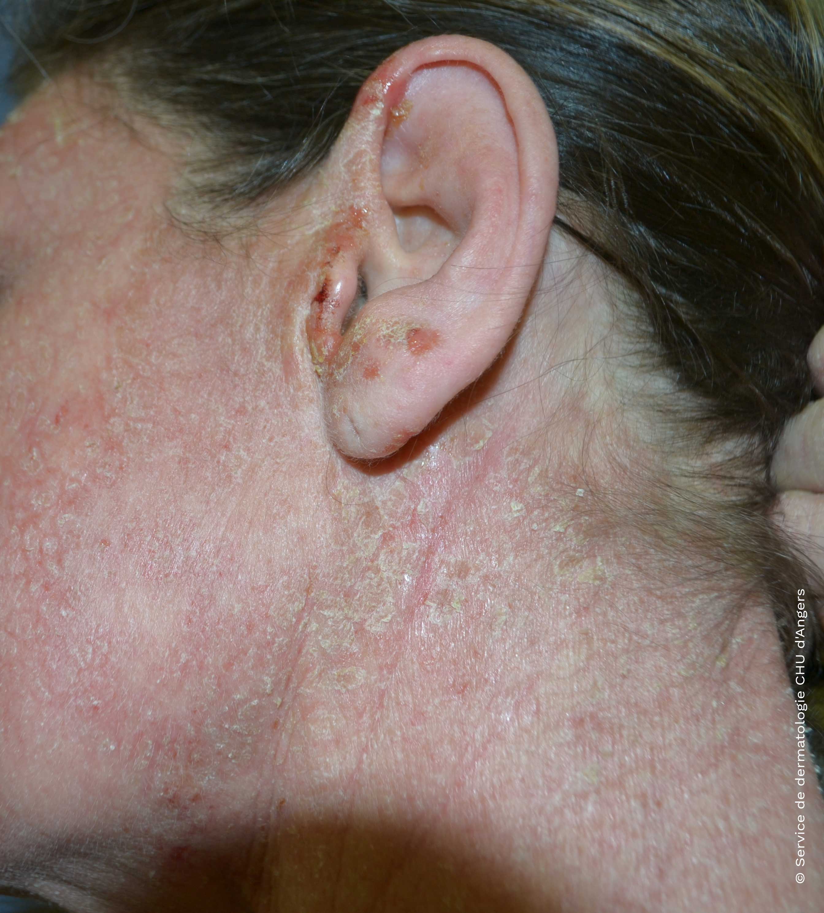 Atopic eczema of the face and neck