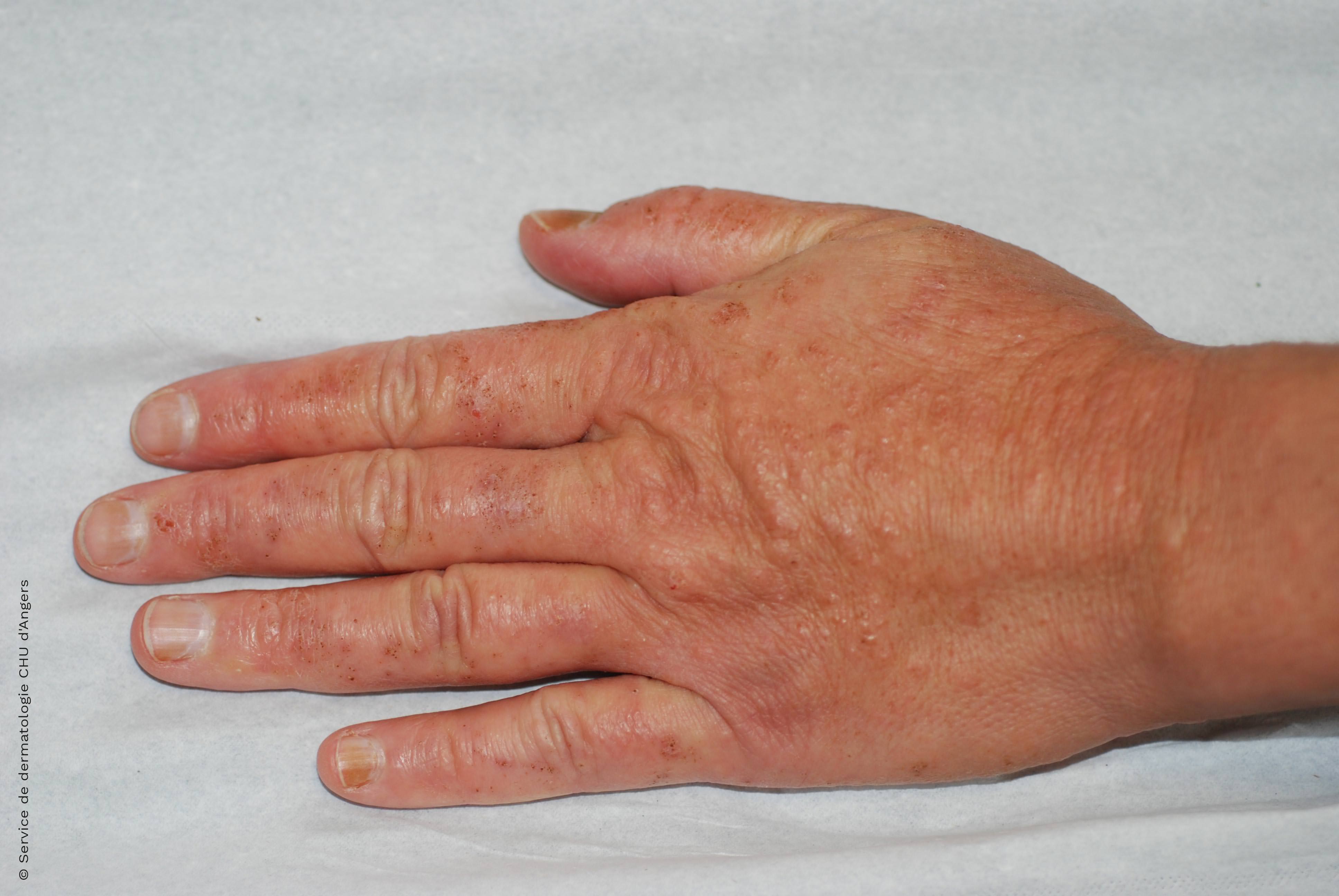 Eczema de contact des mains