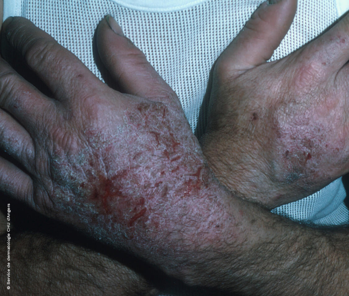 Subacute contact eczema of the hands