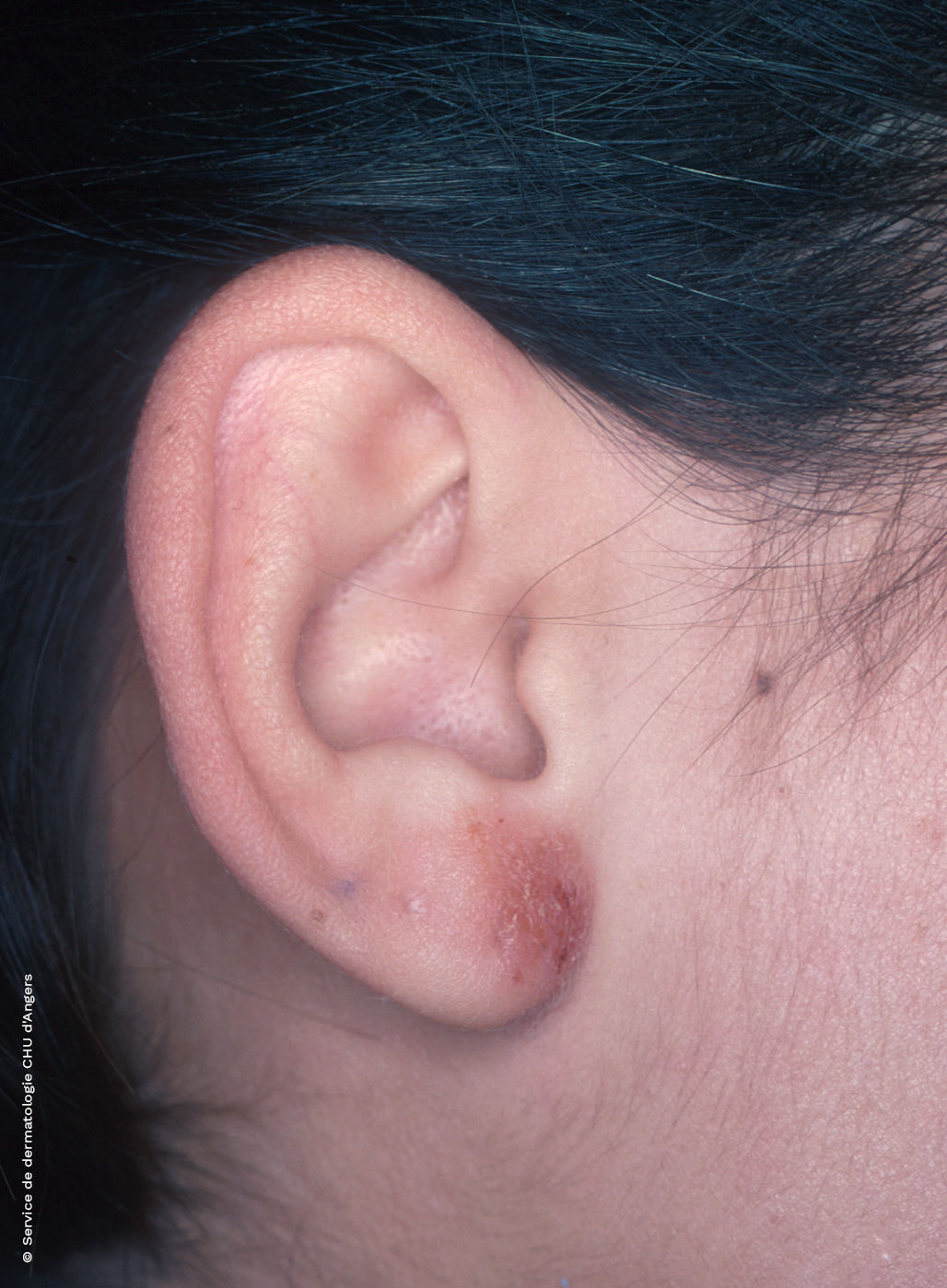 Nickel contact ear eczema