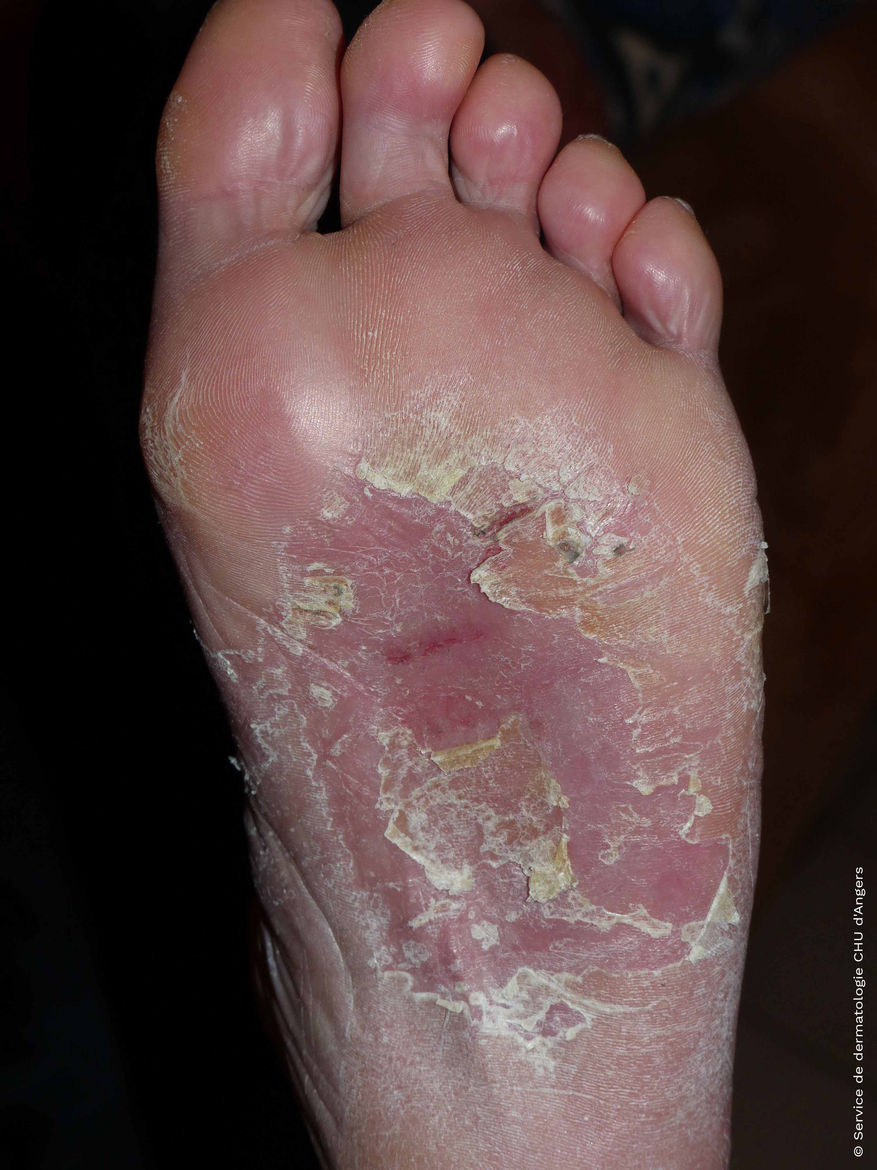 Contact eczema of the feet with glue and shoe leather