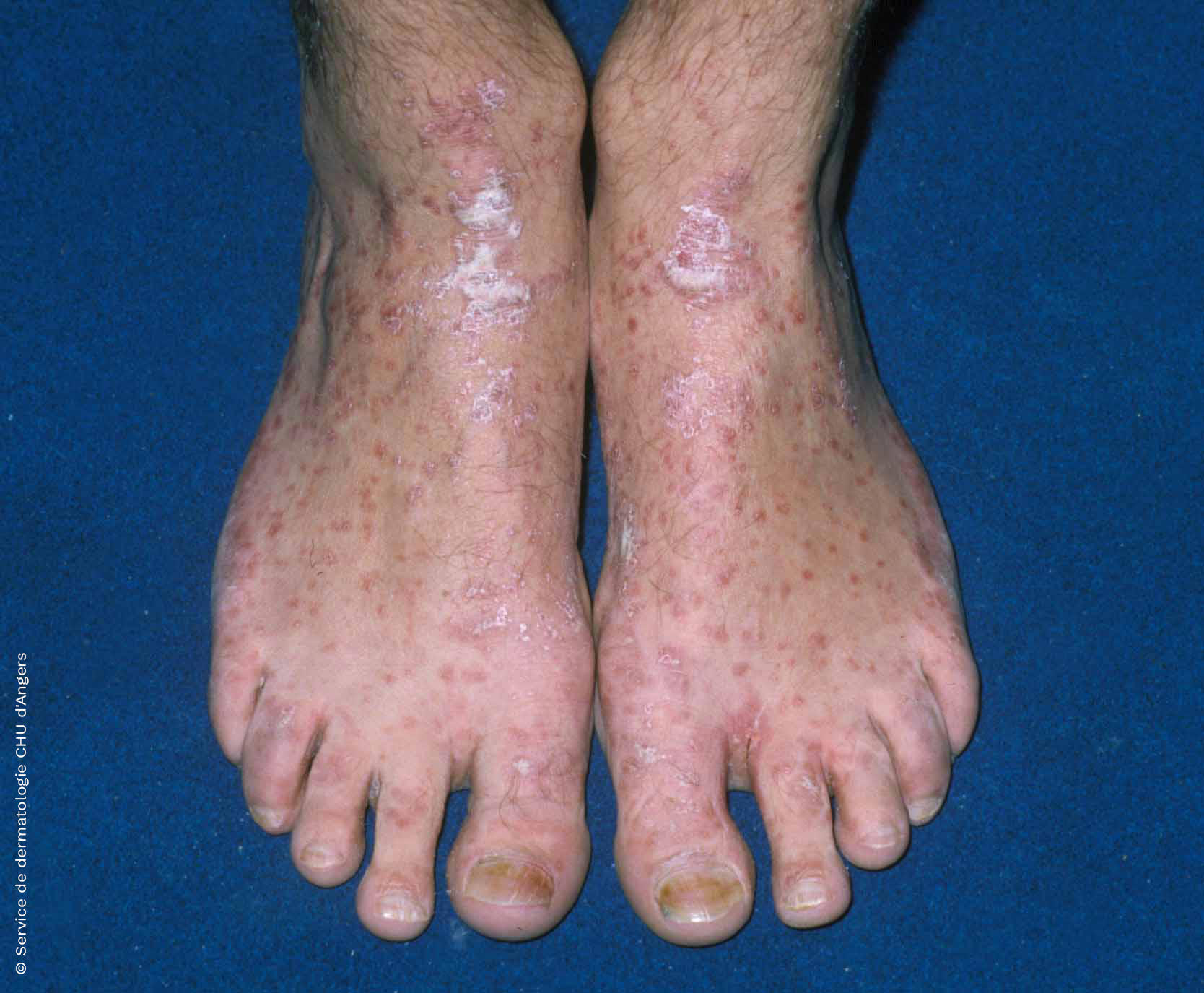 Psoriasis of the feet