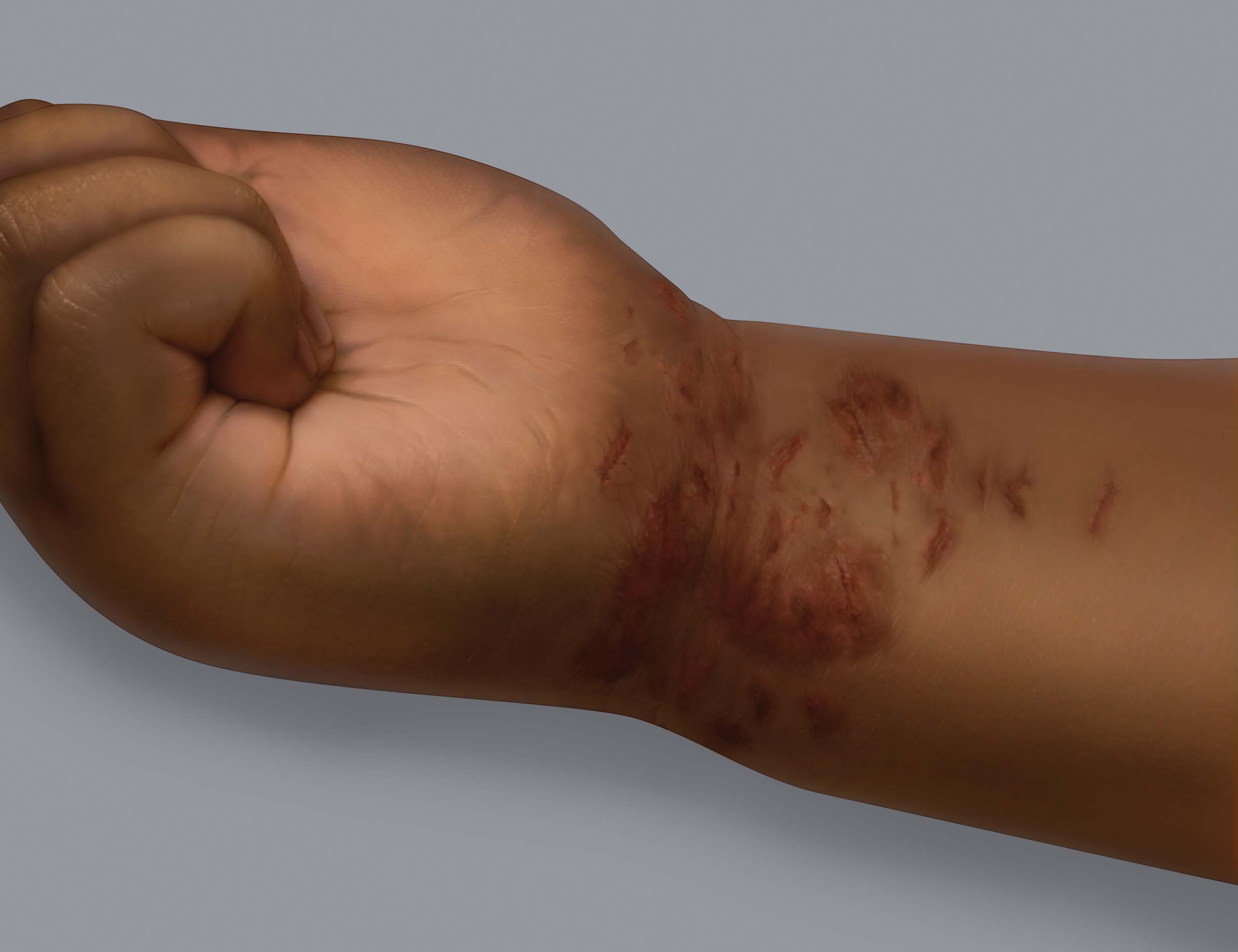 Symptoms of eczema on dark skin: scratch marks (excoriations)