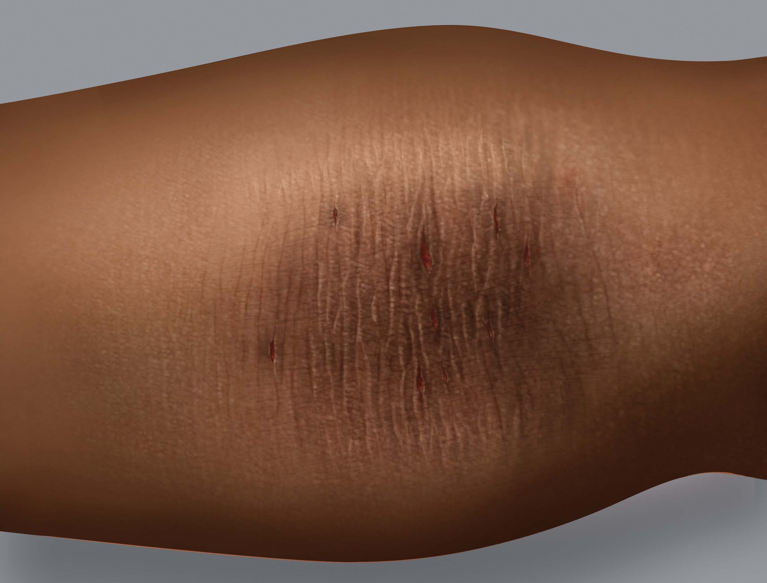 Symptoms of eczema on dark skin: thickening of the skin (lichenification)