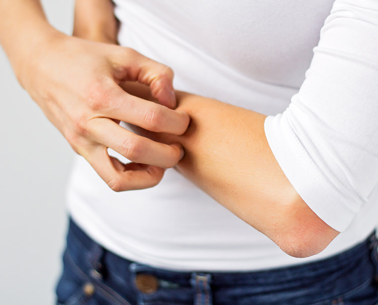 Eczema: astúcias anti-coceira