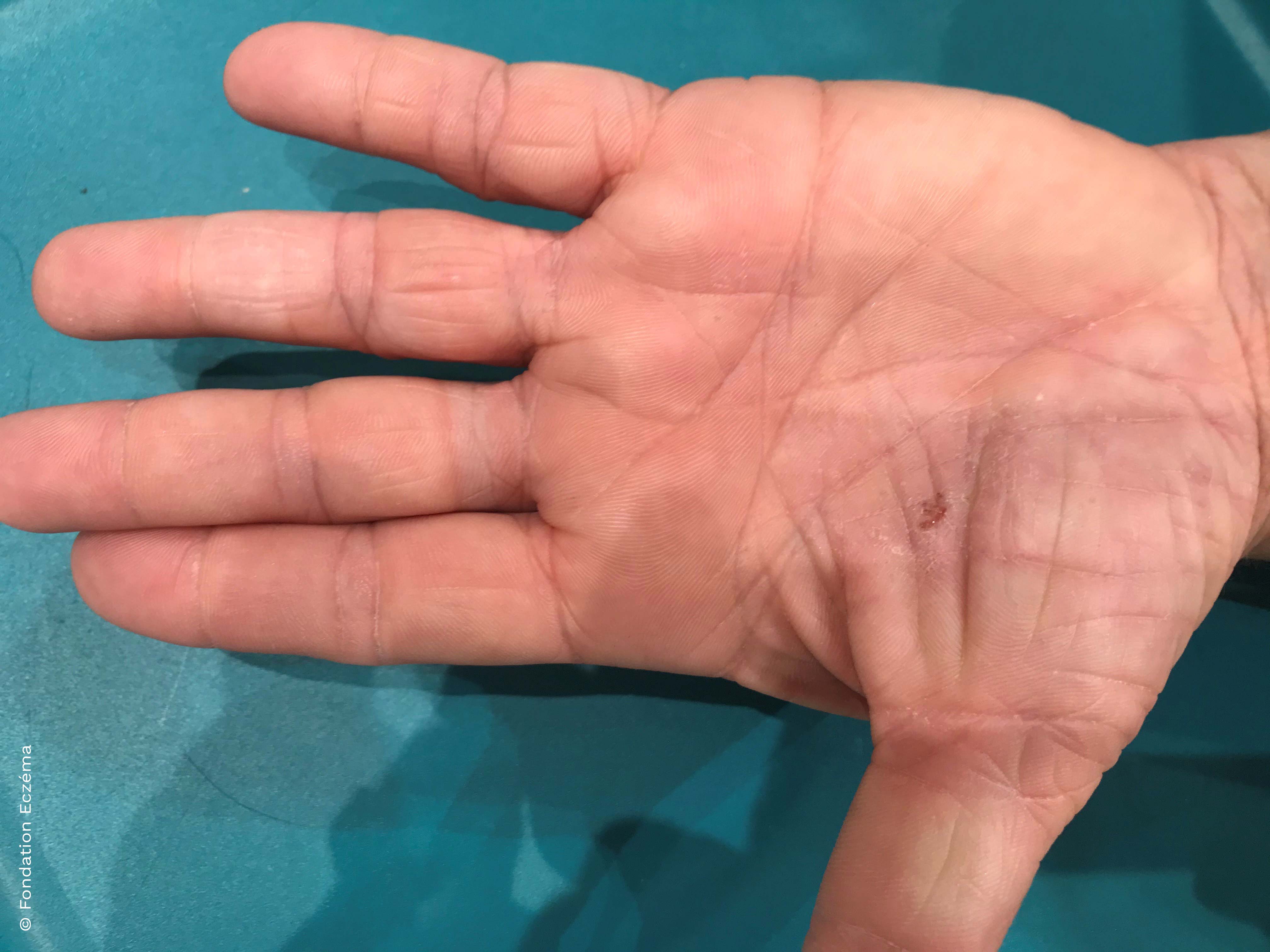 Dermatite atopique des mains de l'adulte