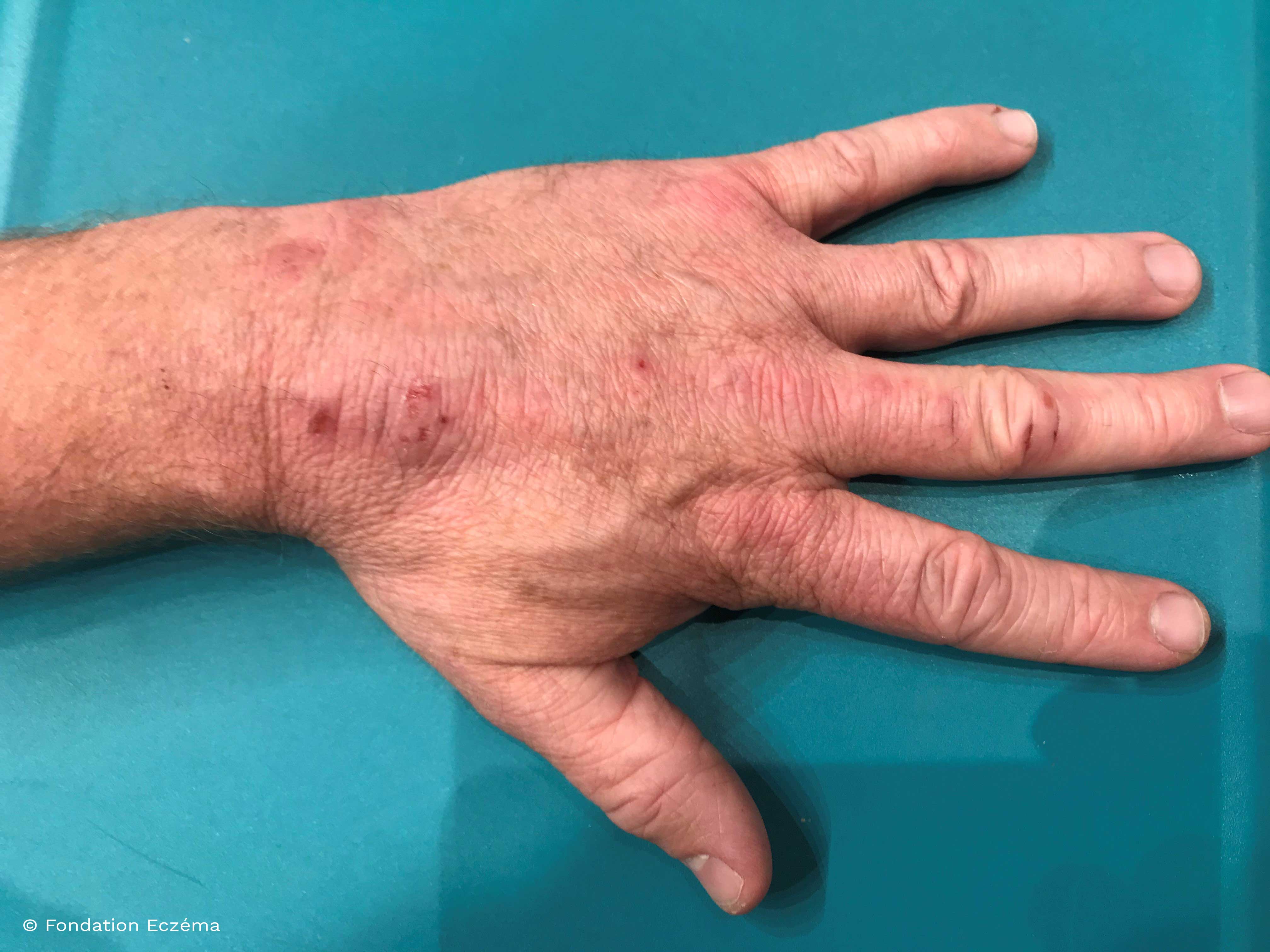 Atopic dermatitis of the hand of a adult