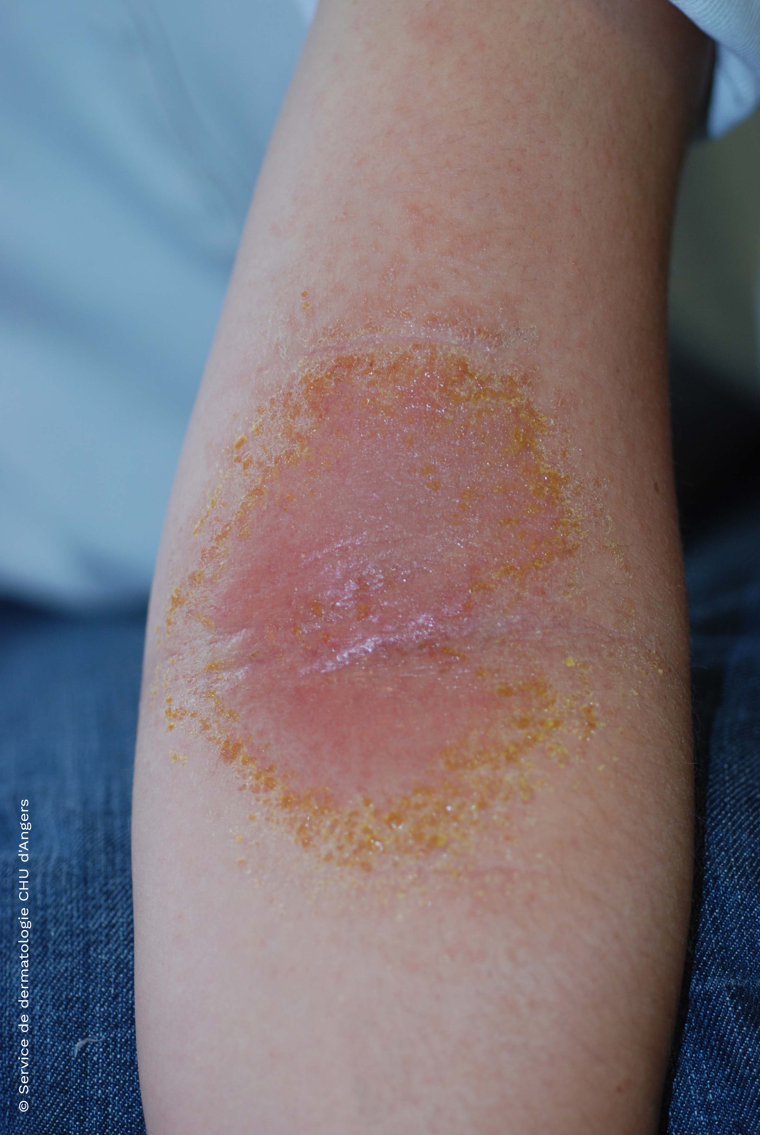 Allergic arm contact eczema