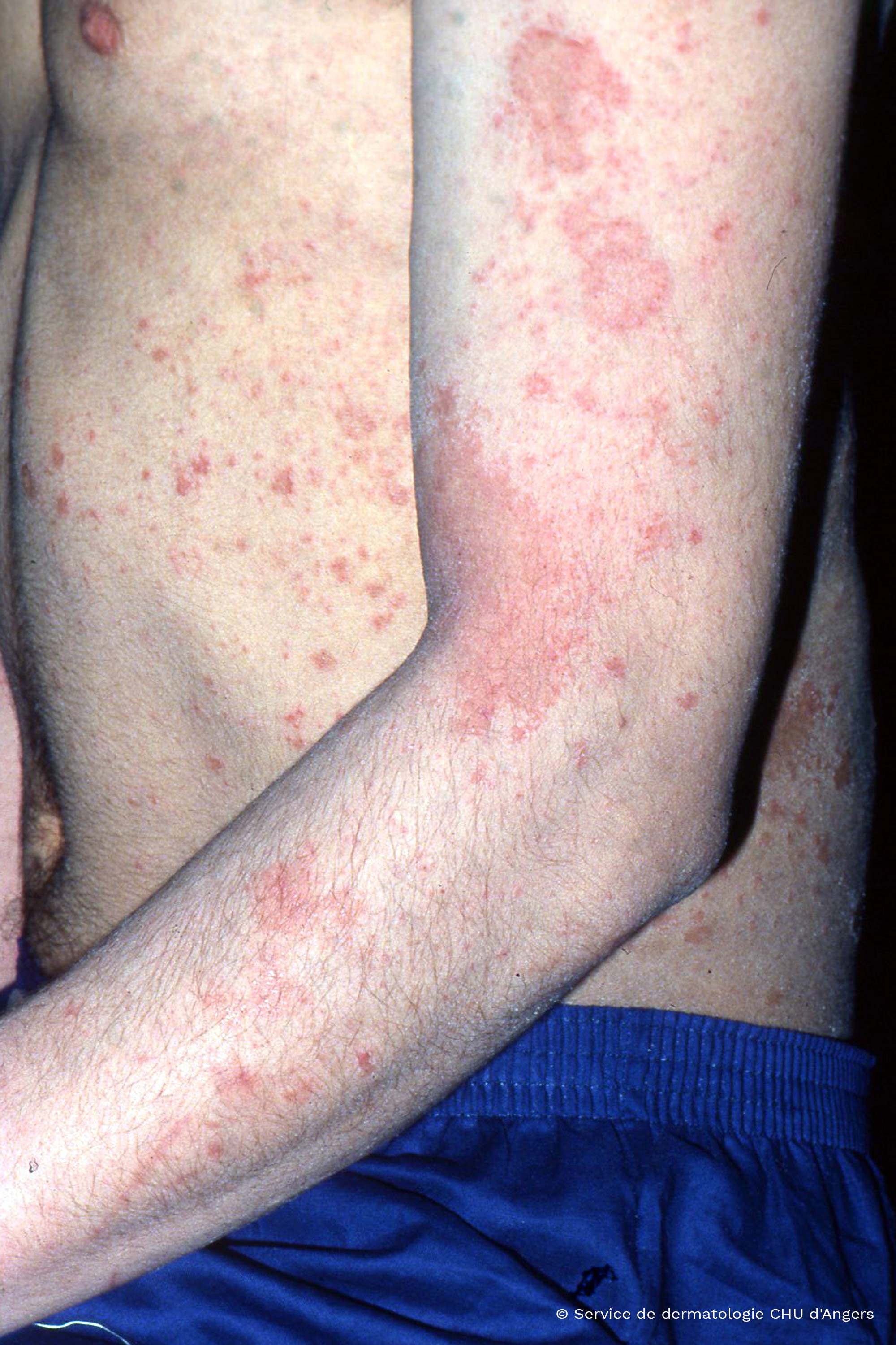 Atopic eczema of the adult arm