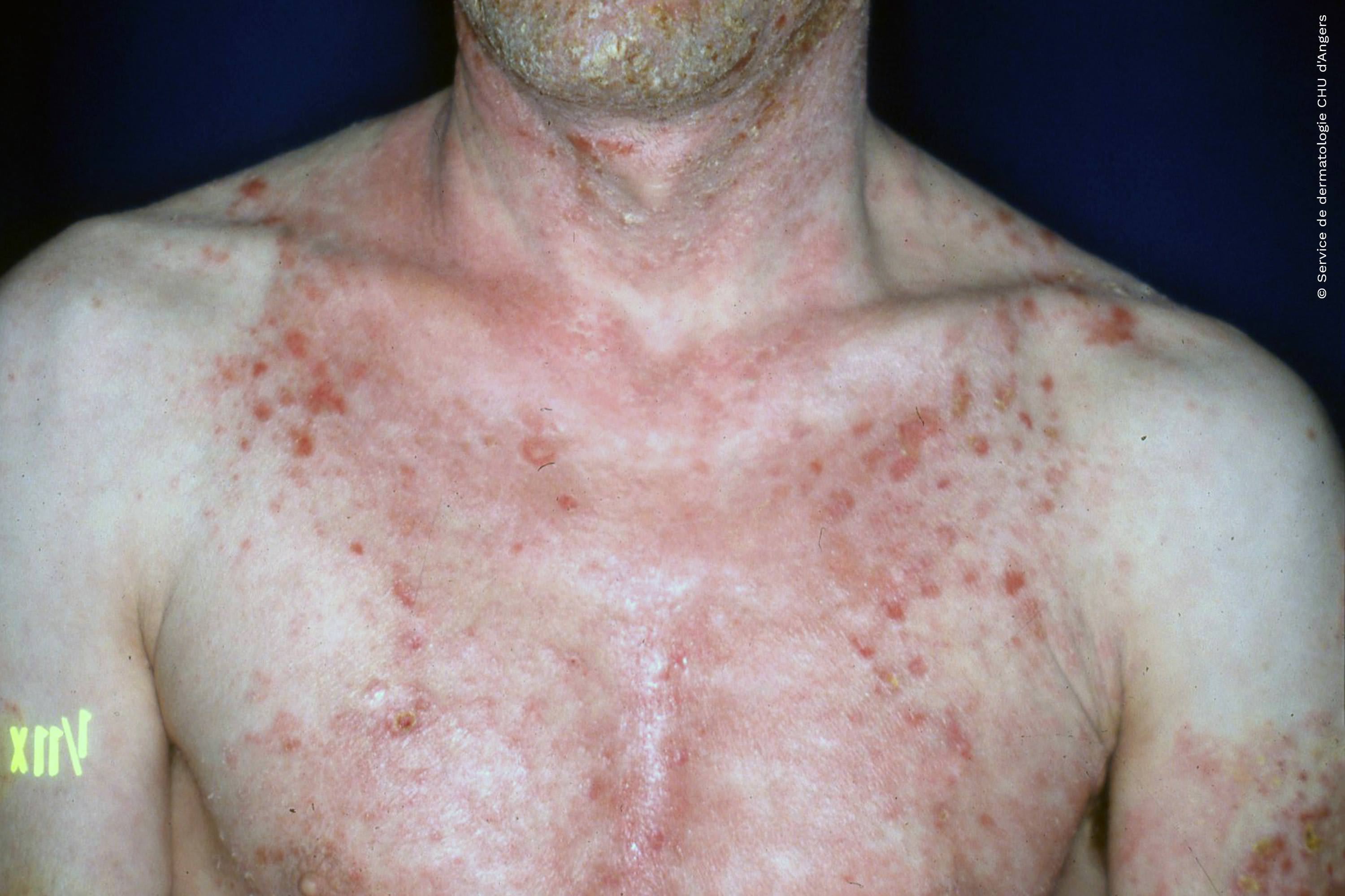 Atopic eczema of the thorax in adults