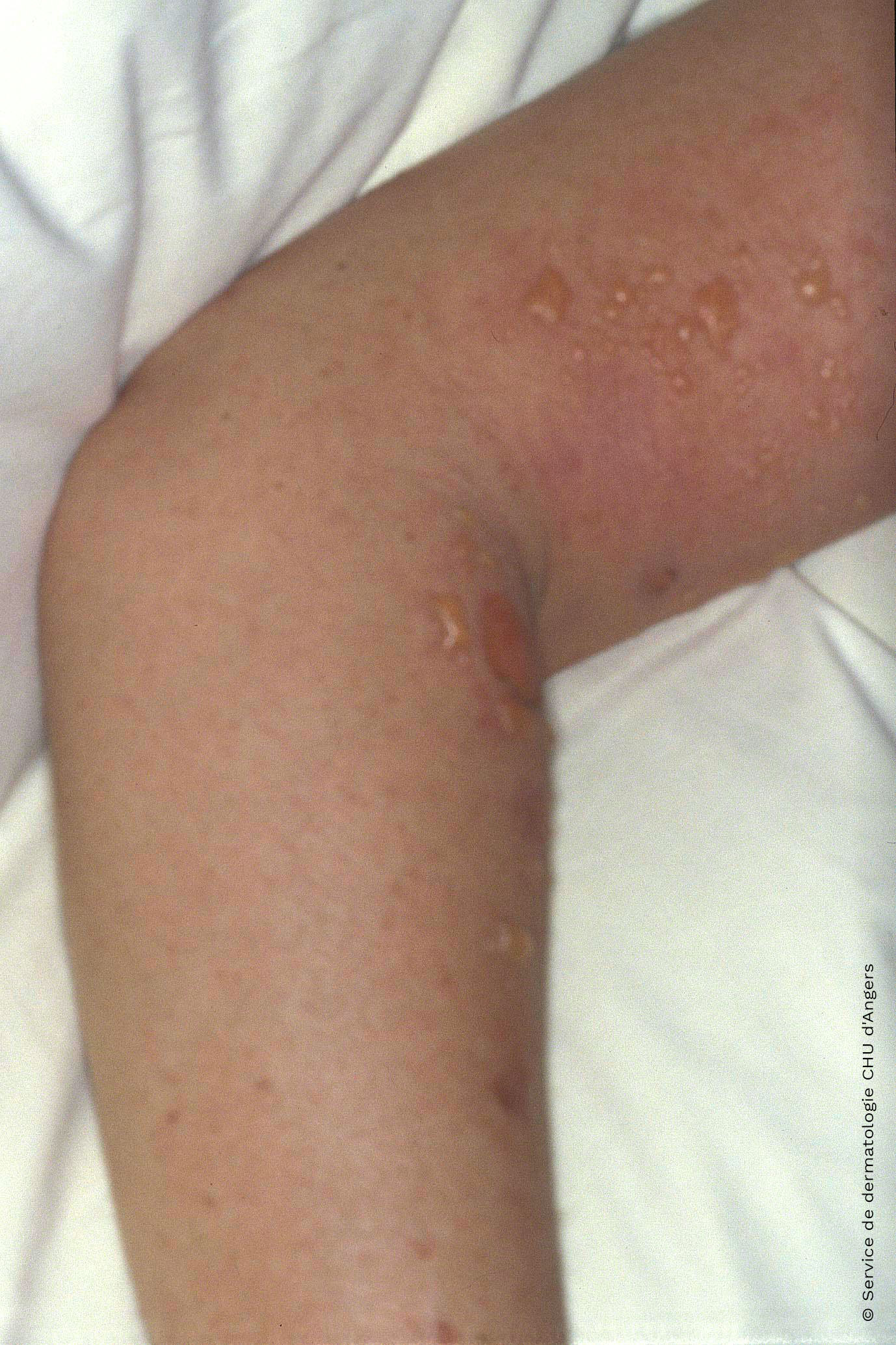 Acute contact eczema of the arm with ketoprofen