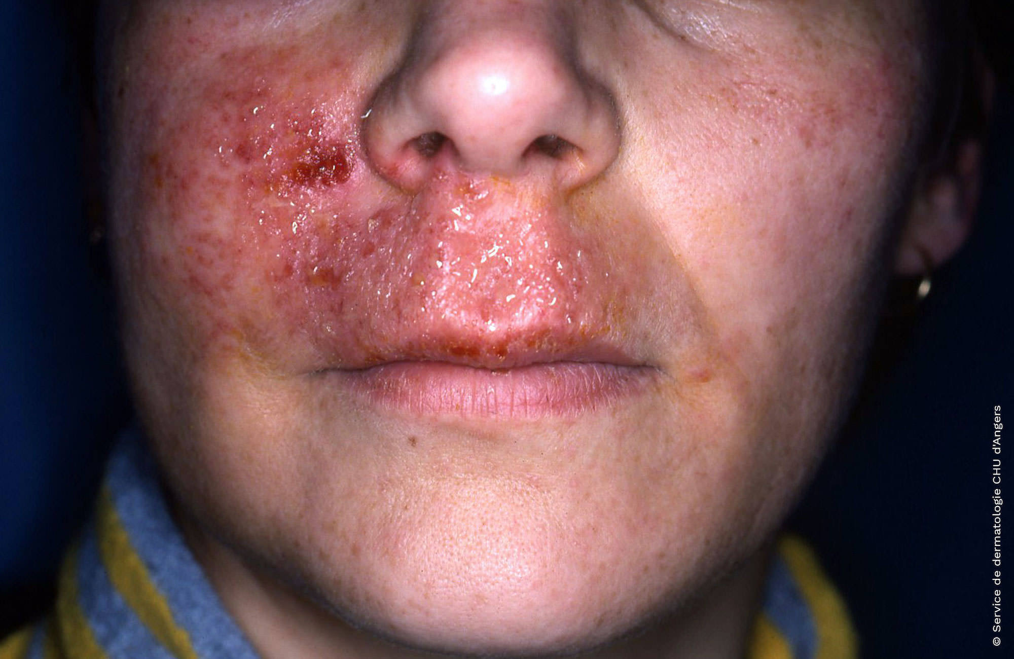 Allergic contact eczema of the face and lips to an antiseptic