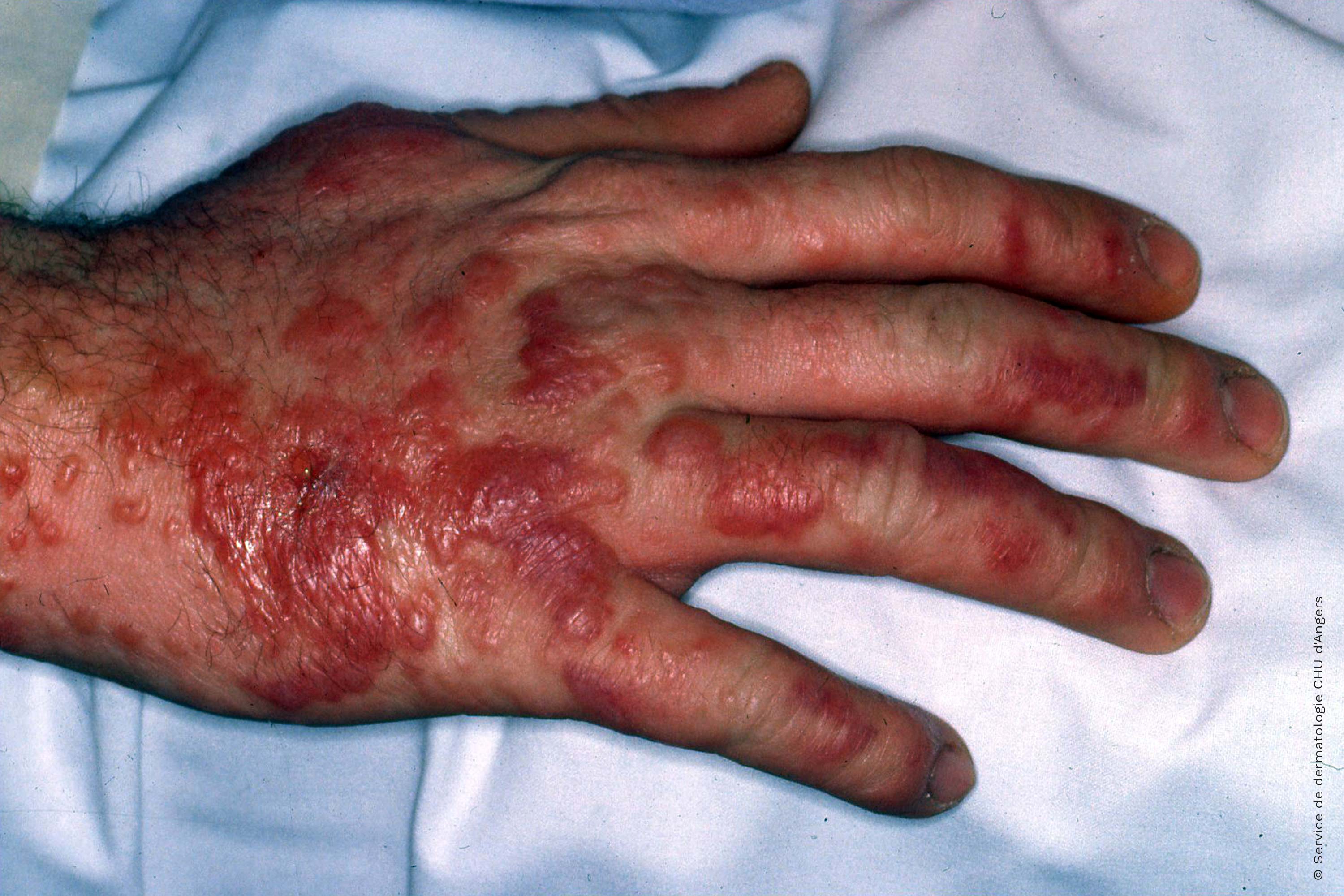 Bubbling allergic contact eczema of the hand due to primrose