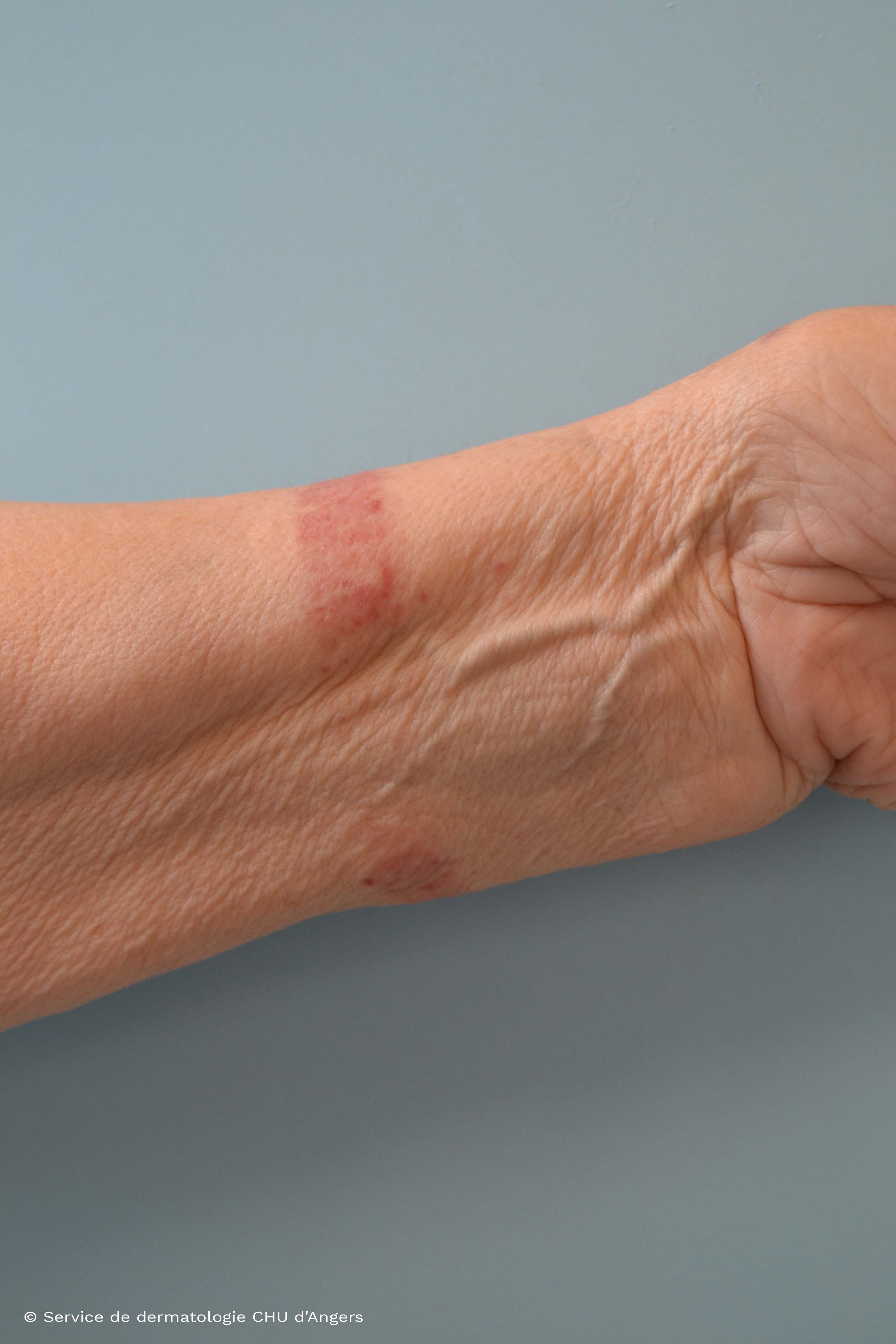 Contact eczema nickel watchband