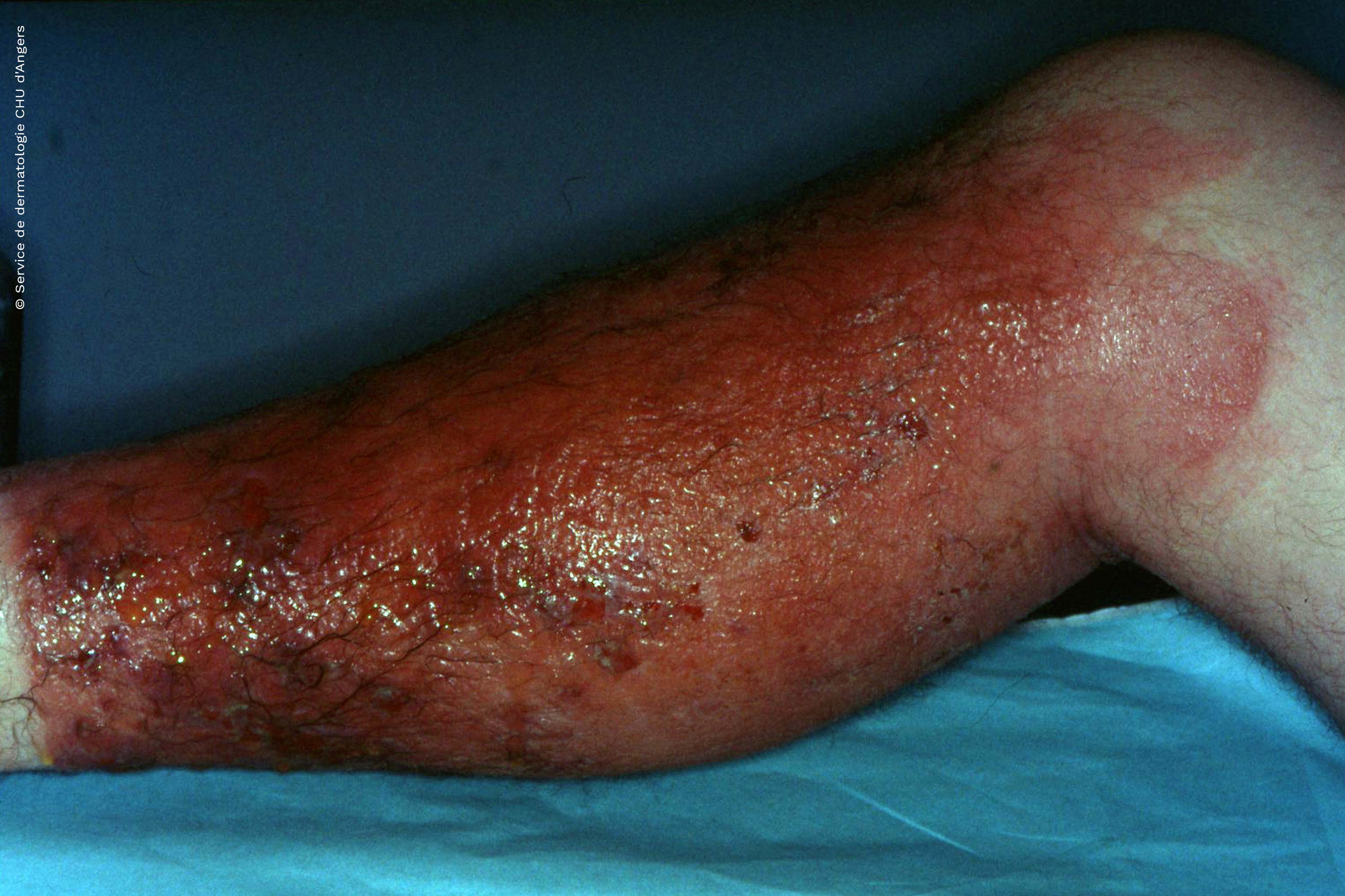 Eczéma de contact photo-allergique jambe au kétoprofène
