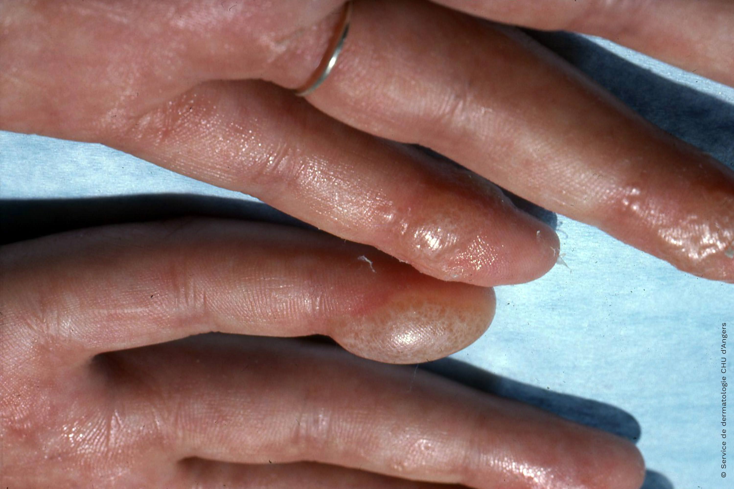 Dysidrotic hand eczema