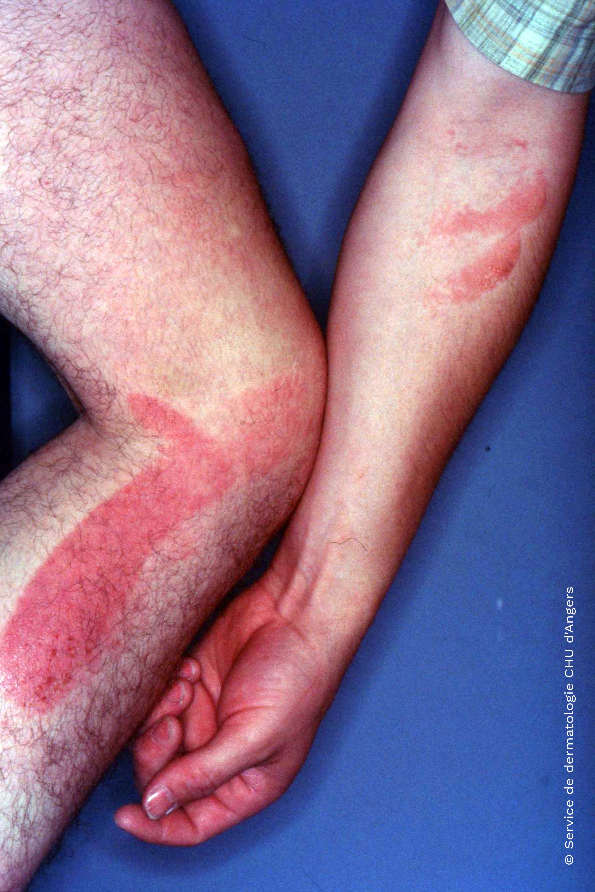 Manually applied eczema with ketoprofen