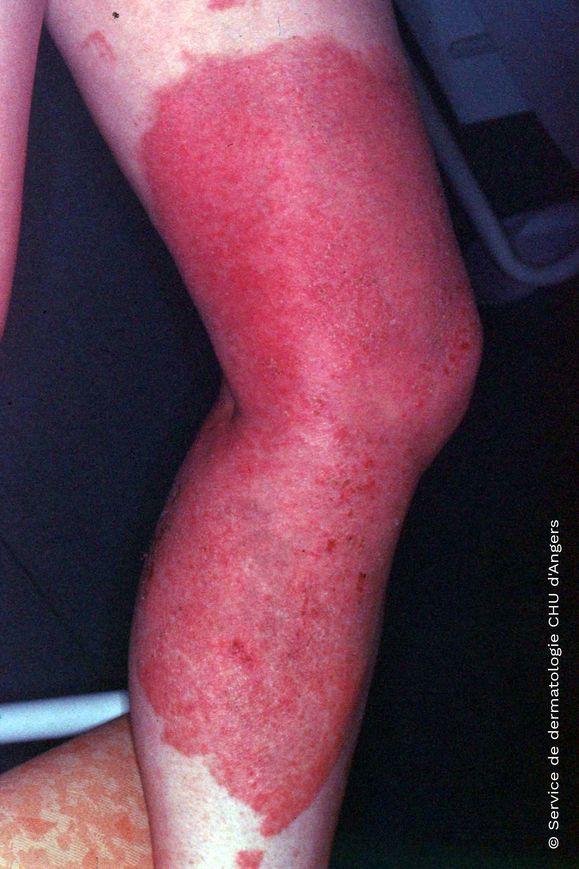 Photo-allergic contact eczema with ketoprofen