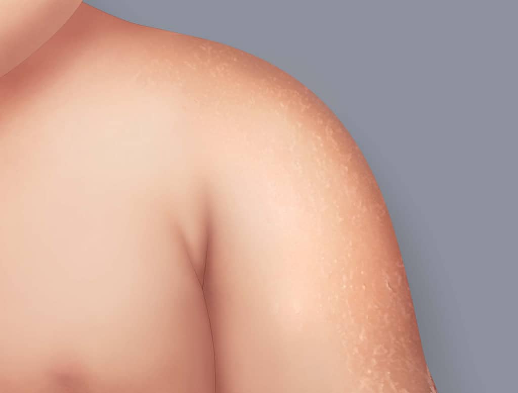 I sintomi dell'eczema atopico: secchezza cutanea chiamata anche xerosi