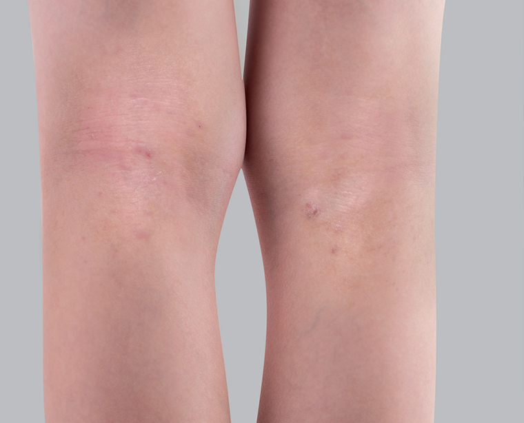 Eczema and scars